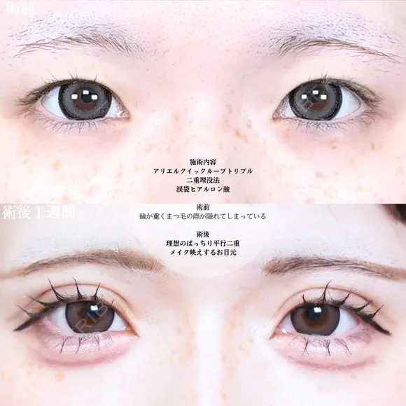 アリエルクイックループトリプル二重埋没法/涙袋ヒアルロン酸 before画像 メイン用