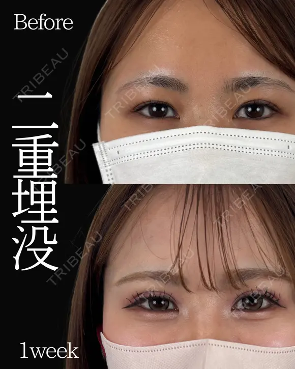 Dr岩切🌟二重埋没🌟 before画像 メイン用
