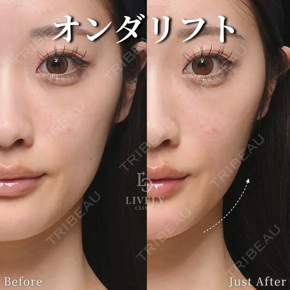 オンダリフト after画像 メイン用