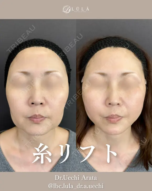 糸リフト before画像 メイン用