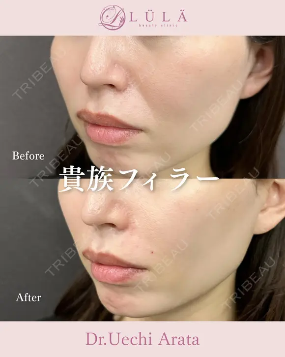 貴族フィラー before画像 メイン用