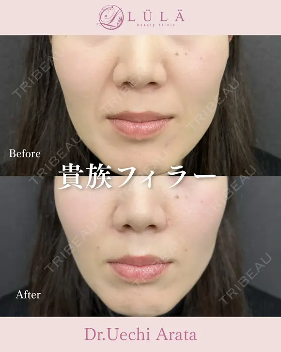 貴族フィラー before画像 メイン用