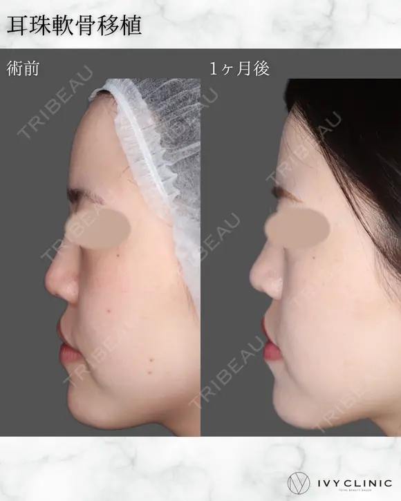 耳珠軟骨移植 after画像 メイン用