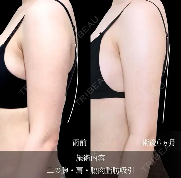 二の腕　肩　脇肉　脂肪吸引 before画像 メイン用