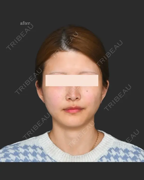 頬脂肪吸引＋エラボトックス 0日後 メイン用