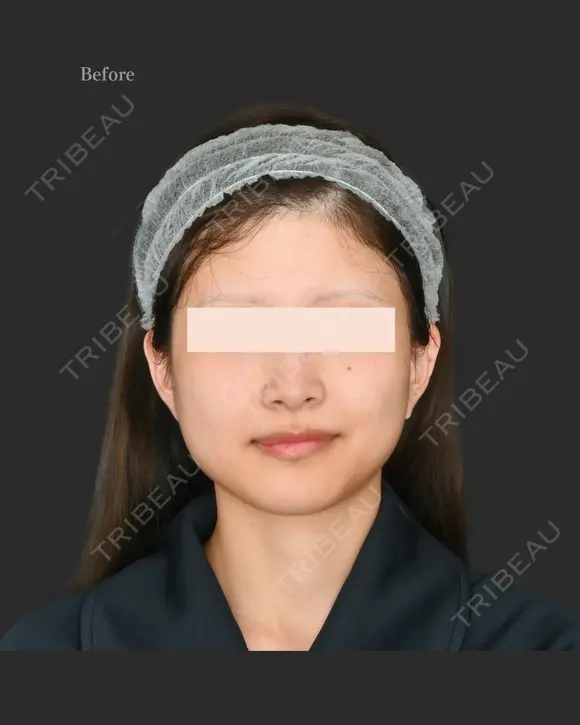 頬脂肪吸引＋エラボトックス before画像 メイン用
