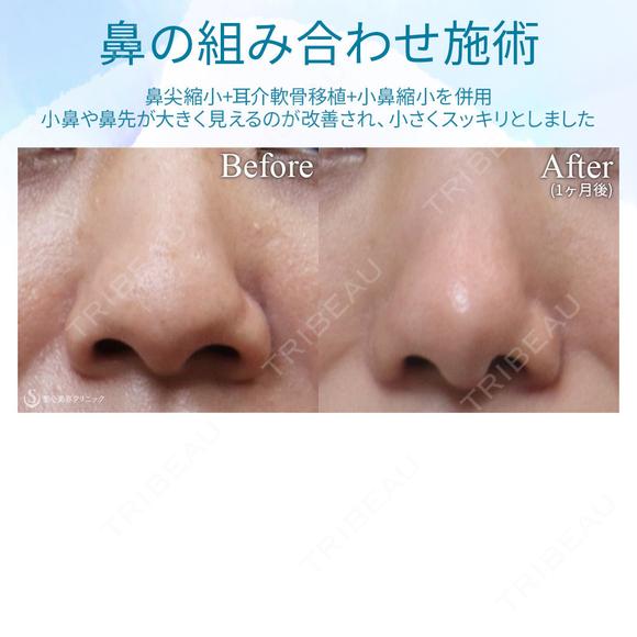 【30代女性・鼻の組み合わせ施術】鼻尖縮小＋鼻尖形成（耳介軟骨移植）＋小鼻縮小 before画像 メイン用