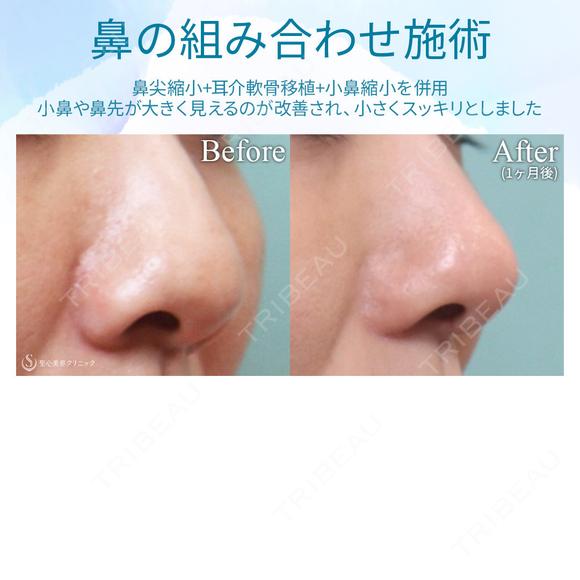 【30代女性・鼻の組み合わせ施術】鼻尖縮小＋鼻尖形成（耳介軟骨移植）＋小鼻縮小 after画像 メイン用