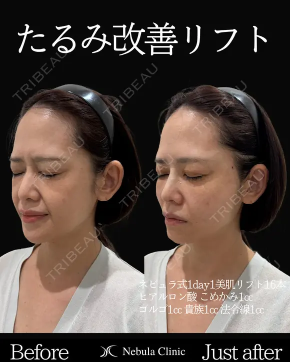 Dr岩切👑小顔整形👑 before画像 メイン用