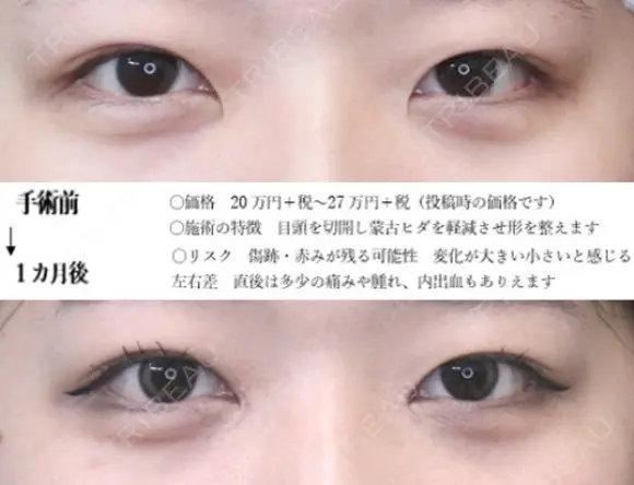目頭切開法 30日後 メイン用