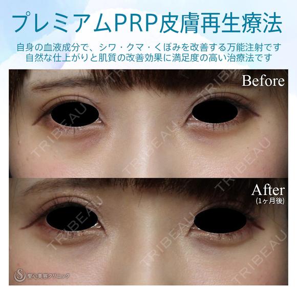 【20代女性・目の下のクマ、たるみ治療】プレミアムPRP皮膚再生療法 before画像 メイン用