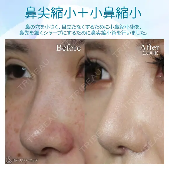 【20代女性・理想の鼻に】鼻の複合手術（プロテーゼ、鼻尖縮小、鼻翼軟骨移植、小鼻縮小） 30日後 メイン用