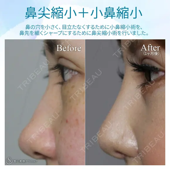 【20代女性・理想の鼻に】鼻の複合手術（プロテーゼ、鼻尖縮小、鼻翼軟骨移植、小鼻縮小） 30日後 メイン用