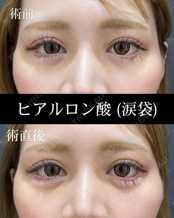 涙袋ヒアルロン酸 before画像 メイン用