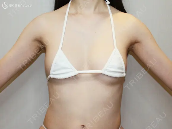 【27歳女性・脂肪幹細胞豊胸】プレミアムセリューション豊胸術（術後2日目〜6ヶ月後） 180日後 メイン用