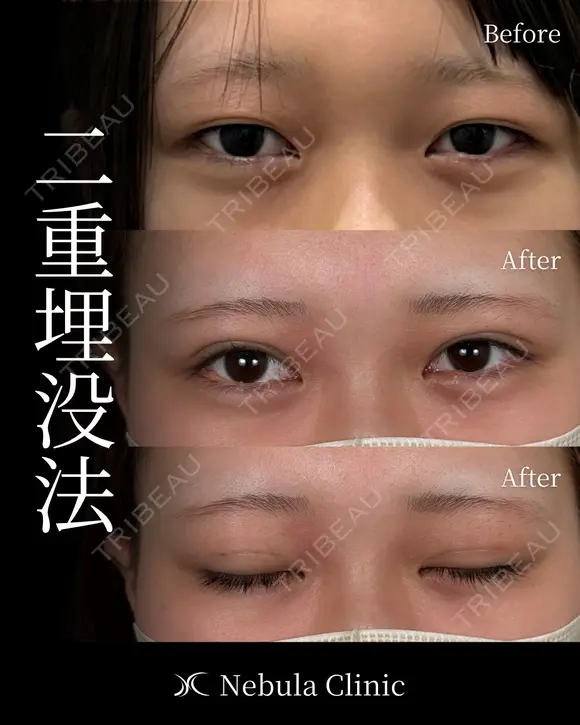 ⭐DR都築⭐ぱっちり垢抜け二重埋没 before画像 メイン用