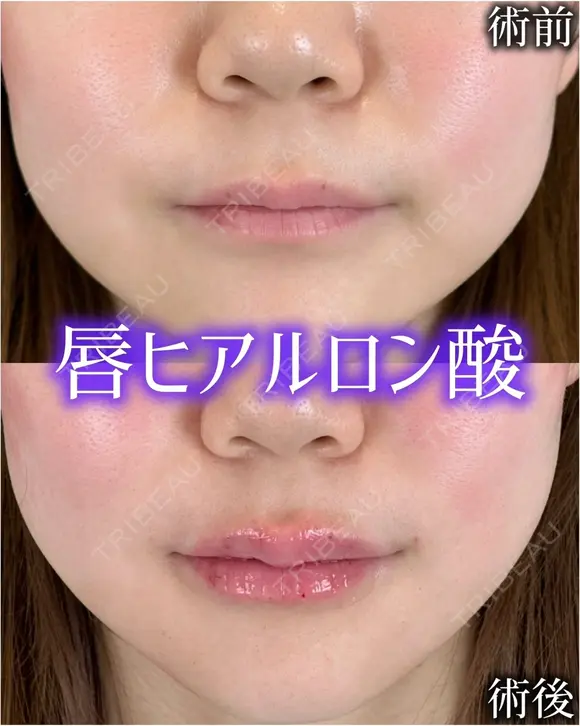 Cカールリップ before画像 メイン用