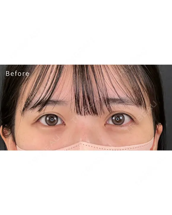 涙袋ヒアルロン酸 before画像 メイン用
