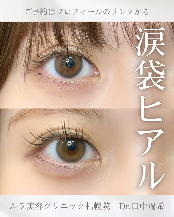 涙袋ヒアルロン酸注入 after画像 メイン用