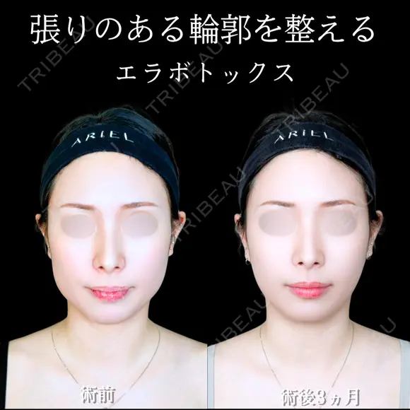 エラボトックス 90日後 メイン用