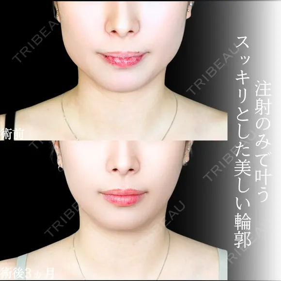 エラボトックス before画像 メイン用