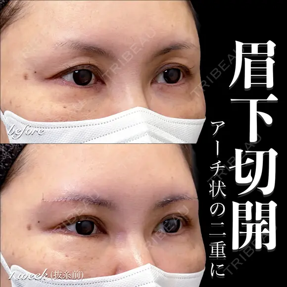 眉下切開 7日後 メイン用