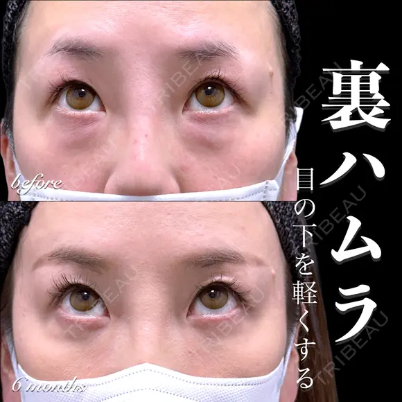 裏ハムラ 180日後 メイン用