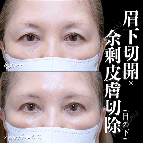 眉下切開･余剰皮膚切除(目の下) 7日後 メイン用