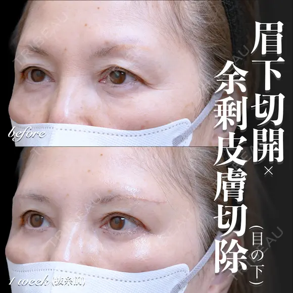 眉下切開･余剰皮膚切除(目の下) 7日後 メイン用
