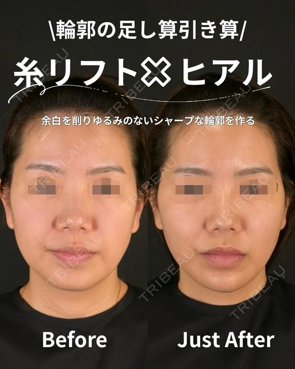 余白を削りゆるみのないシャープな輪郭を作ろ 0日後 メイン用