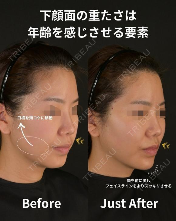 余白を削りゆるみのないシャープな輪郭を作ろ 0日後 メイン用