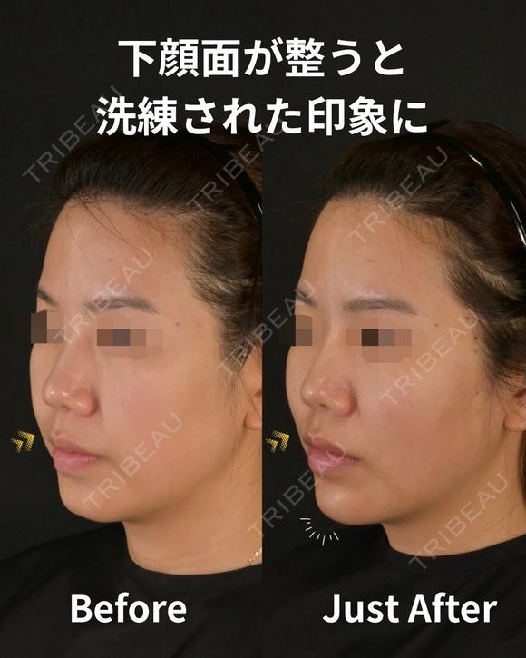 余白を削りゆるみのないシャープな輪郭を作ろ 0日後 メイン用