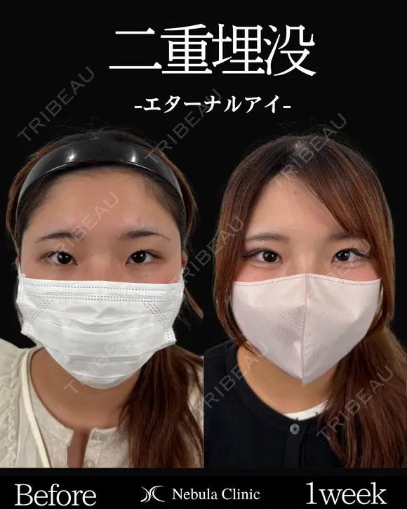 Dr岩切🎀二重埋没🎀 before画像 メイン用
