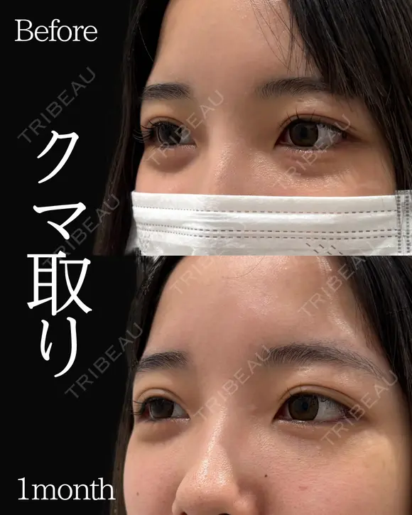 岩切医師による🔥クマ取り🔥 before画像 メイン用