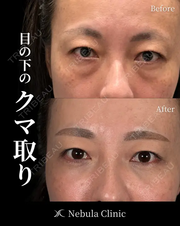 🐻DR都築🐻切らないクマ取り before画像 メイン用