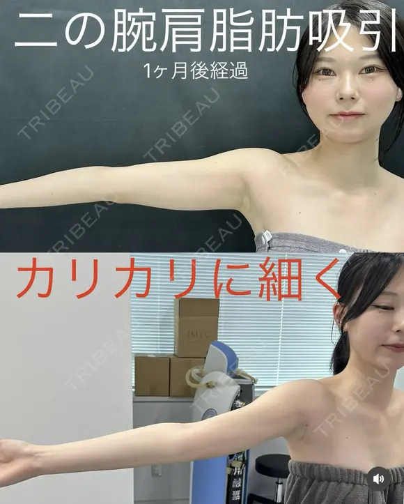 脂肪吸引　二の腕＋肩 after画像 メイン用