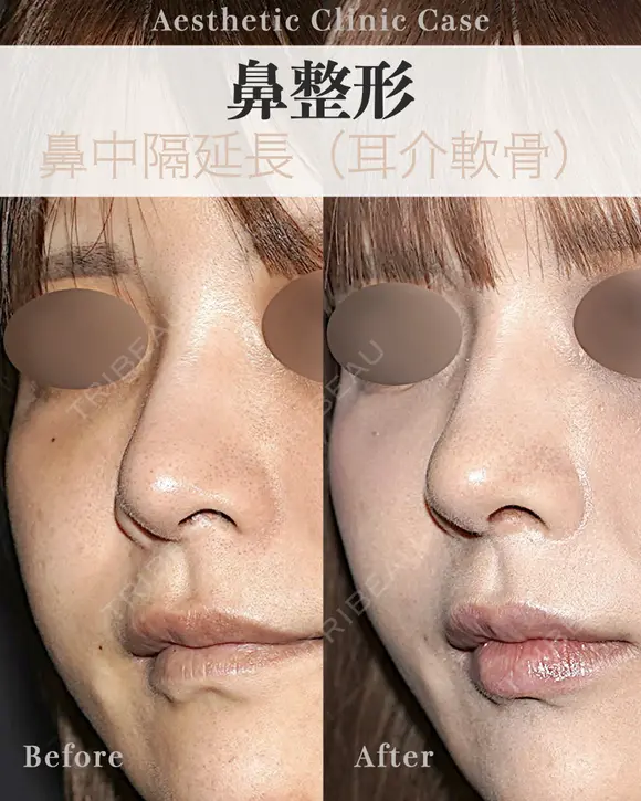 鼻中隔延長　耳介軟骨使用 after画像 メイン用