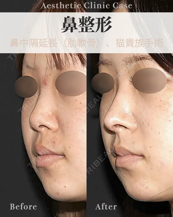 鼻中隔延長肋軟骨使用　猫手術・貴族手術 after画像 メイン用