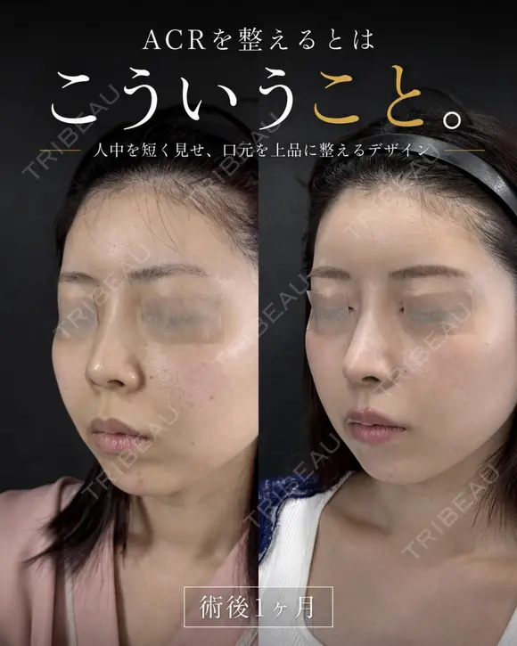 鼻フル after画像 メイン用