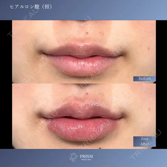 唇ヒアルロン酸 0日後 メイン用