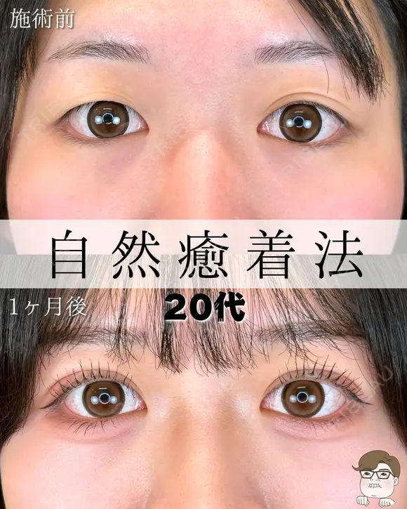 自然癒着法（エターナル二重術） before画像 メイン用