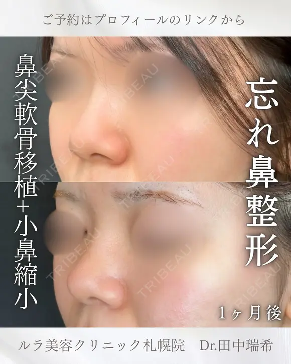 鼻尖形成耳介軟骨移植（クローズ法）・小鼻縮小（切開法） before画像 メイン用