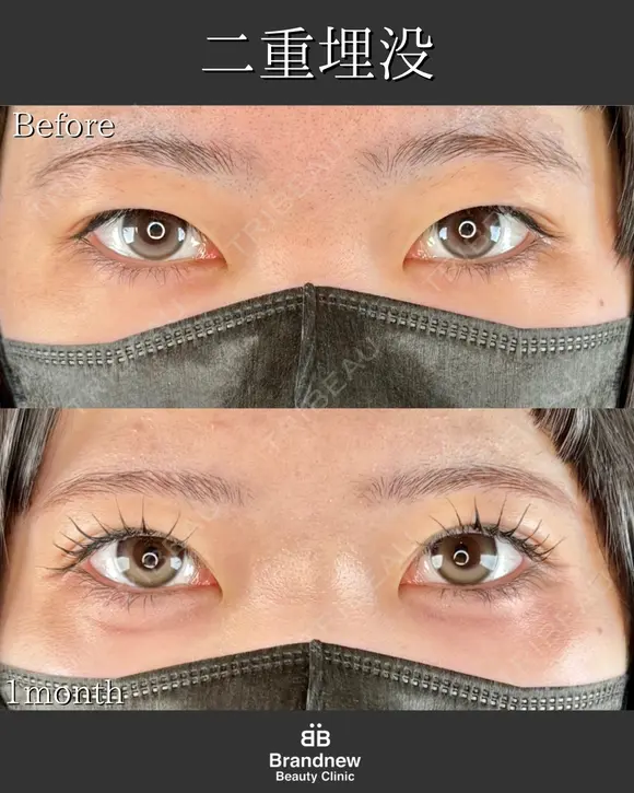 オーダーメイド二重埋没法 before画像 メイン用
