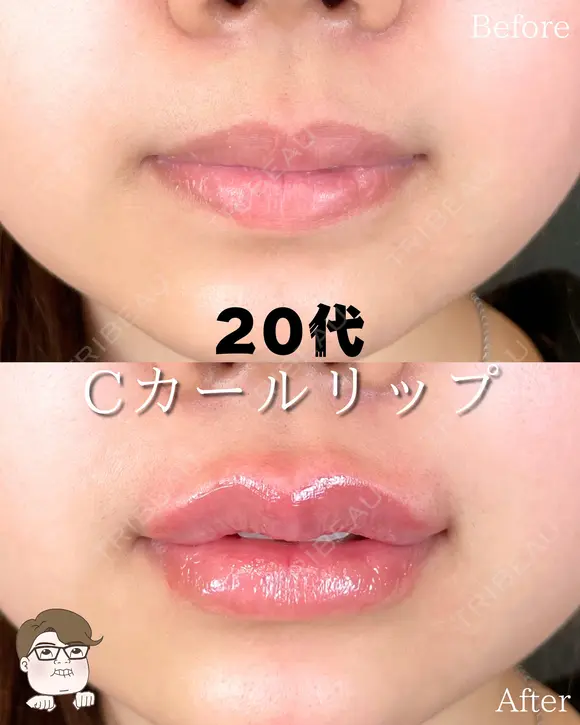 Cカールリップ before画像 メイン用