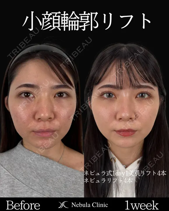 Dr岩切👑小顔整形👑 before画像 メイン用