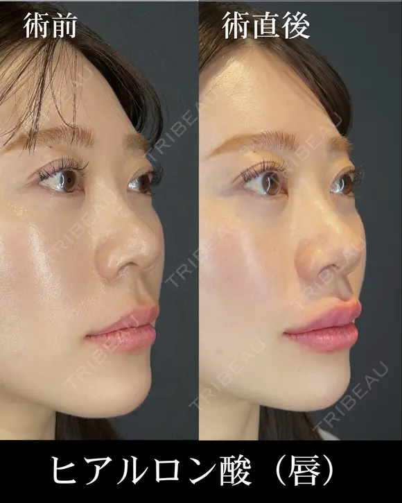 ヒアルロン酸注入（唇） before画像 メイン用