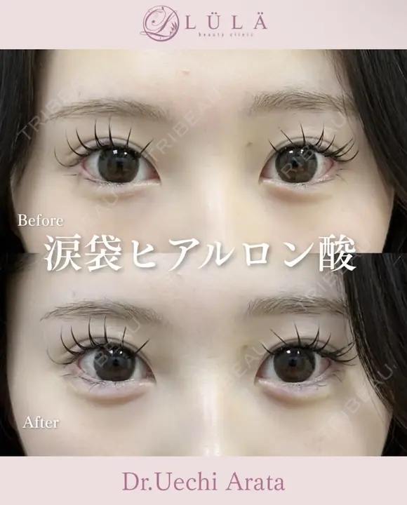 涙袋ヒアルロン酸 before画像 メイン用