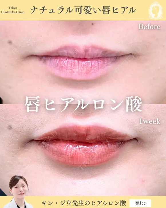 ヒアルロン酸注入（唇） before画像 メイン用