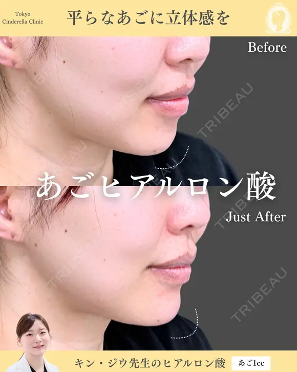 ヒアルロン酸注入（あご） before画像 メイン用