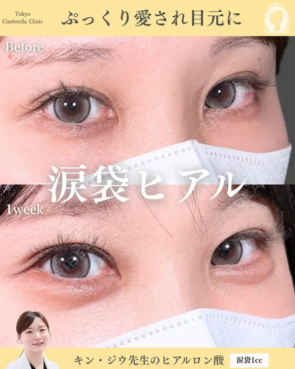 ヒアルロン酸注入（涙袋） before画像 メイン用